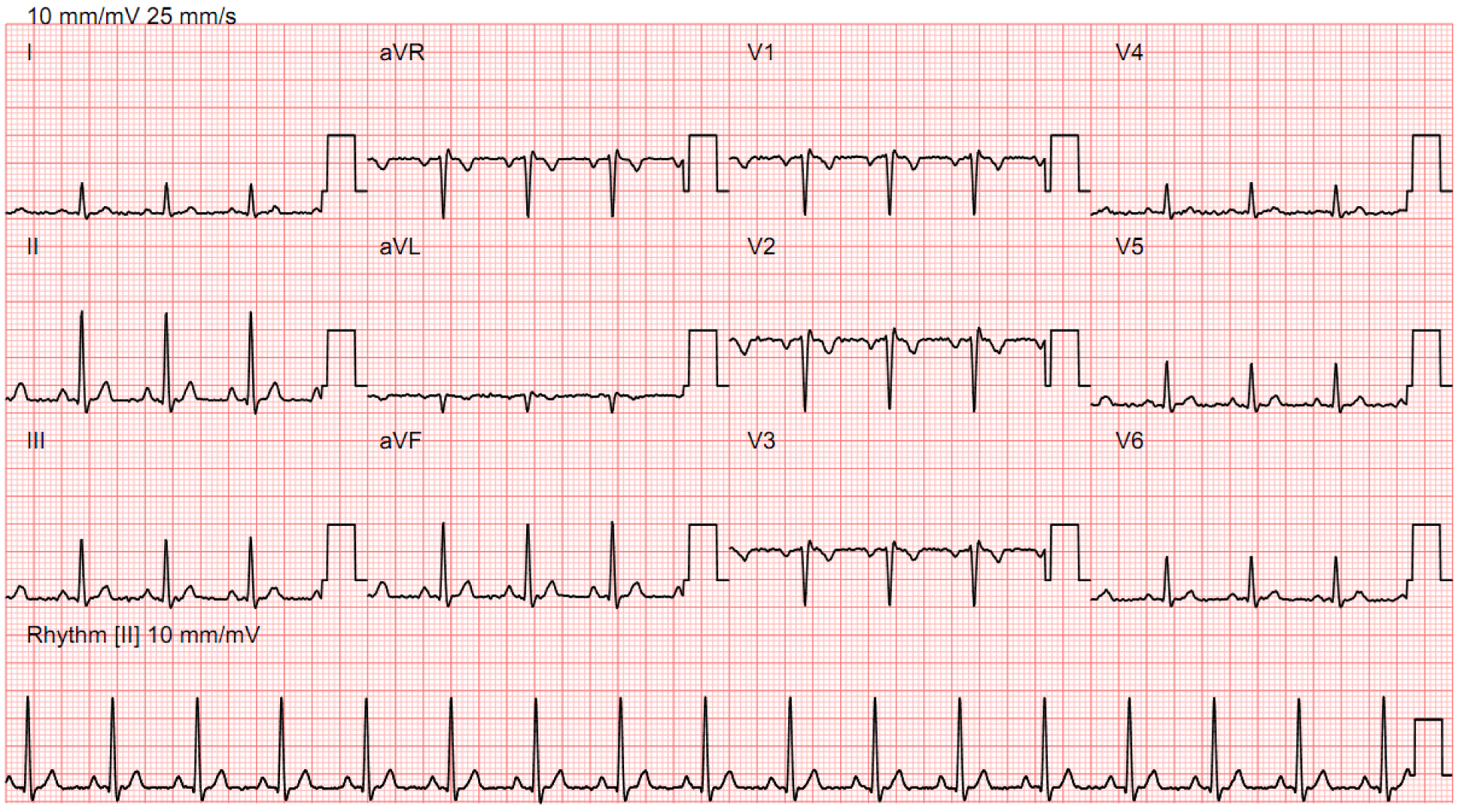 ecg